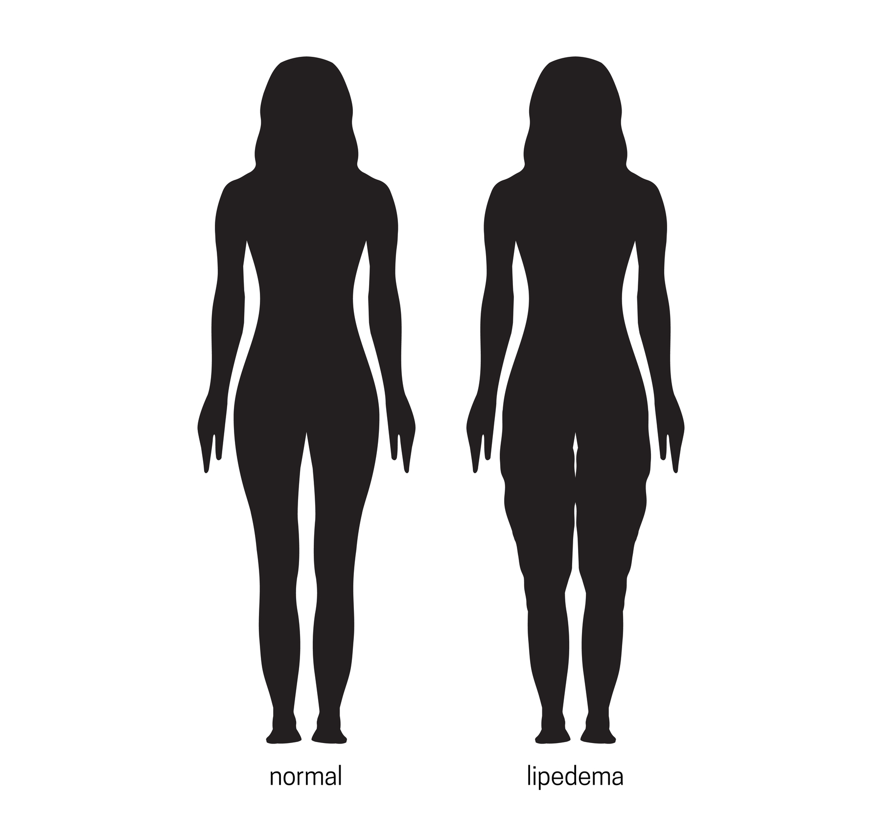 infografía Lipedema